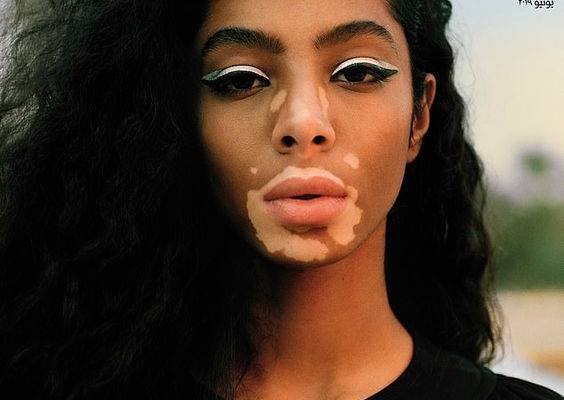 Winnie Harlow covers Vogue Arabia with another model who has vitiligo